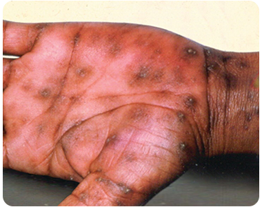 Syphilis-Rising_Stage2_1