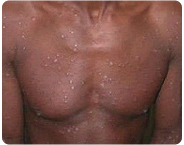 Syphilis-Rising_Stage2_3