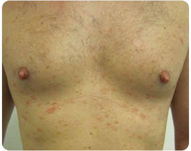 Syphilis-Rising_Stage2_4